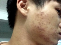 如何去除痘痘有效果